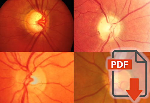 Influence of nifedipine on the visual fields of patients with optic-nerve-head diseases